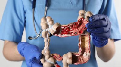 Colon Cancer and Surgery Options