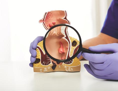 Colorectal Cancer - HealthWorks Winter 2025